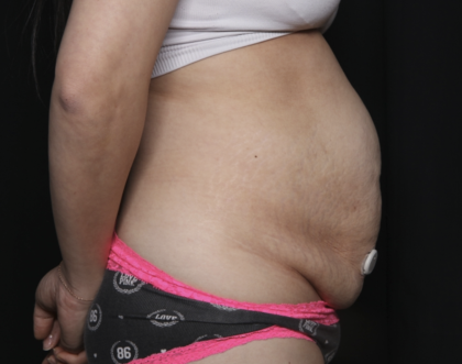 Tummy Tuck Before & After Patient #36340