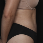 Tummy Tuck Before & After Patient #36340