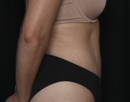 Tummy Tuck Before & After Patient #36340