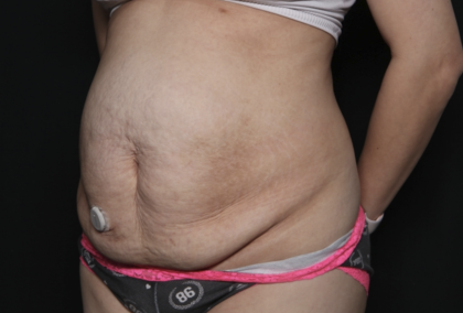 Tummy Tuck Before & After Patient #36340