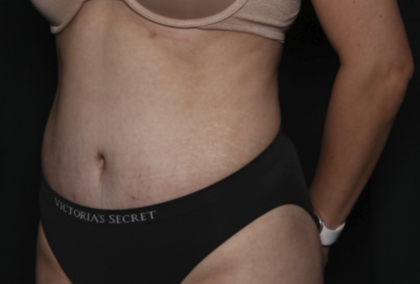 Tummy Tuck Before & After Patient #36340