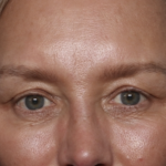 Upper Blepharoplasty Before & After Patient #36351