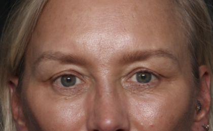 Upper Blepharoplasty Before & After Patient #36351
