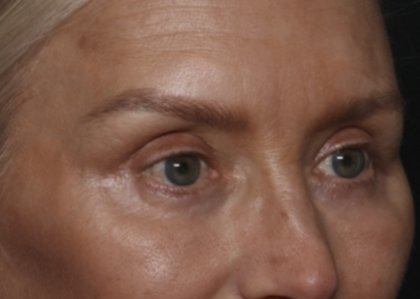Upper Blepharoplasty Before & After Patient #36351