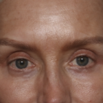 Upper Blepharoplasty Before & After Patient #36351
