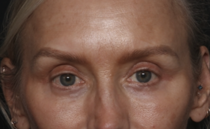 Upper Blepharoplasty Before & After Patient #36351