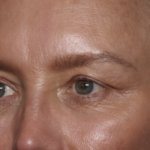 Upper Blepharoplasty Before & After Patient #36351