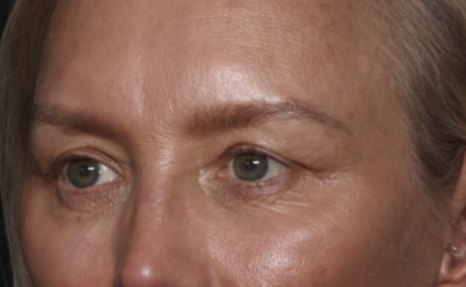 Upper Blepharoplasty Before & After Patient #36351