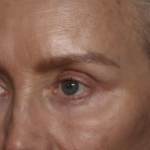 Upper Blepharoplasty Before & After Patient #36351