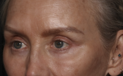 Upper Blepharoplasty Before & After Patient #36351