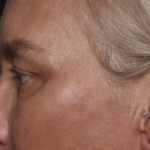 Upper Blepharoplasty Before & After Patient #36351