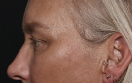 Upper Blepharoplasty Before & After Patient #36351