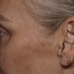 Upper Blepharoplasty Before & After Patient #36351