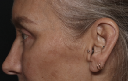Upper Blepharoplasty Before & After Patient #36351