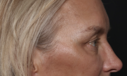 Upper Blepharoplasty Before & After Patient #36351