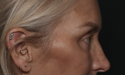 Upper Blepharoplasty Before & After Patient #36351
