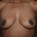 Breast Augmentation Before & After Patient #36419