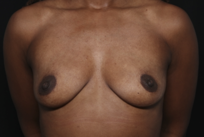 Breast Augmentation Before & After Patient #36419