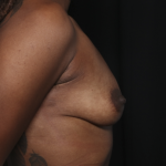 Breast Augmentation Before & After Patient #36419