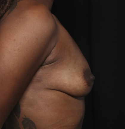 Breast Augmentation Before & After Patient #36419