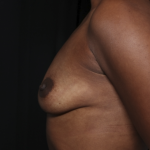 Breast Augmentation Before & After Patient #36419