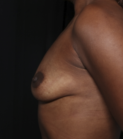 Breast Augmentation Before & After Patient #36419
