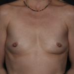 Breast Augmentation Before & After Patient #36428
