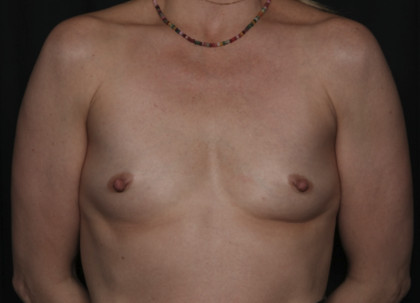 Breast Augmentation Before & After Patient #36428
