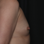 Breast Augmentation Before & After Patient #36428