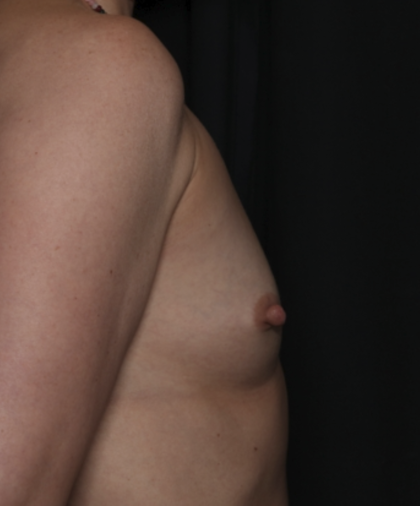 Breast Augmentation Before & After Patient #36428