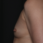 Breast Augmentation Before & After Patient #36428