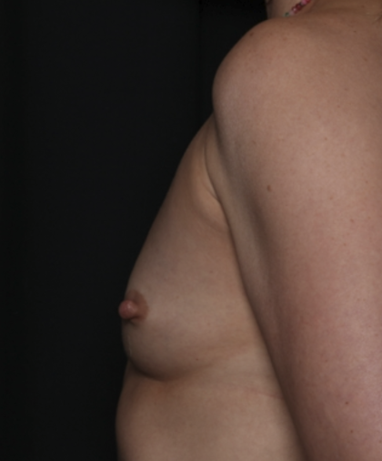 Breast Augmentation Before & After Patient #36428