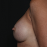 Breast Augmentation Before & After Patient #36428