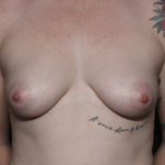 Breast Lift with Implant Before & After Patient #36408
