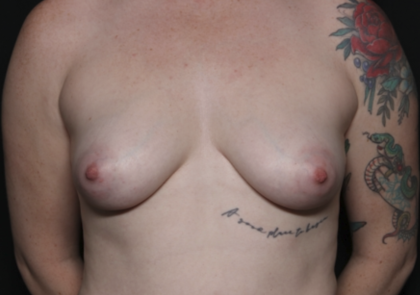 Breast Lift with Implant Before & After Patient #36408