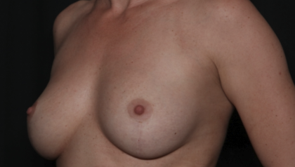 Breast Lift Before & After Patient #36386