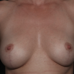 Breast Lift Before & After Patient #36386