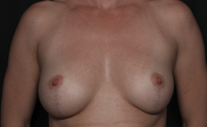 Breast Lift Before & After Patient #36386