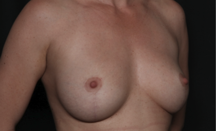 Breast Lift Before & After Patient #36386