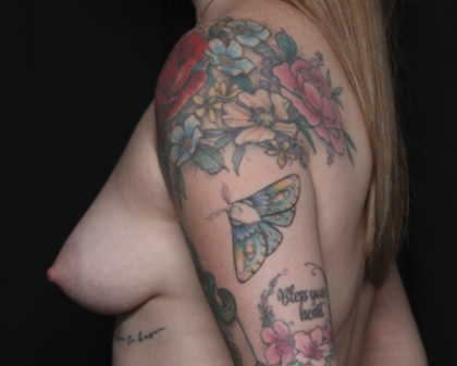 Breast Lift with Implant Before & After Patient #36408