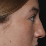 Rhinoplasty Before & After Patient #36397