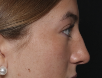 Rhinoplasty Before & After Patient #36397