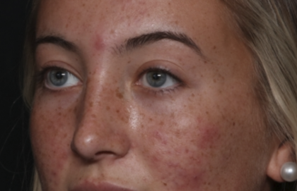 Rhinoplasty Before & After Patient #36397