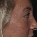 Rhinoplasty Before & After Patient #36397