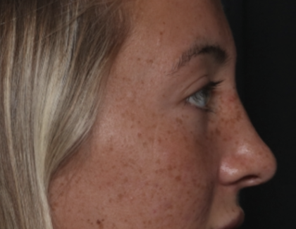 Rhinoplasty Before & After Patient #36397