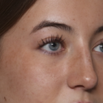 Rhinoplasty Before & After Patient #36397