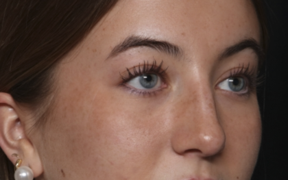 Rhinoplasty Before & After Patient #36397