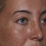 Rhinoplasty Before & After Patient #36397