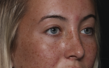 Rhinoplasty Before & After Patient #36397