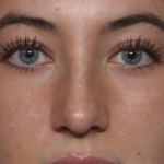 Rhinoplasty Before & After Patient #36397